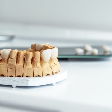 How Long Do All-Ceramic Crowns Last?