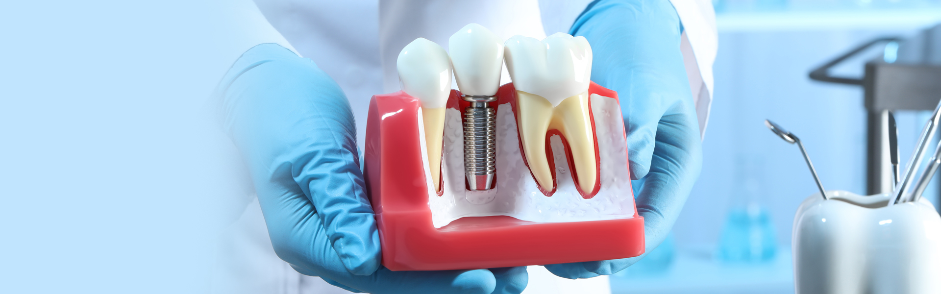 Do Dental Implants Require Crowns?