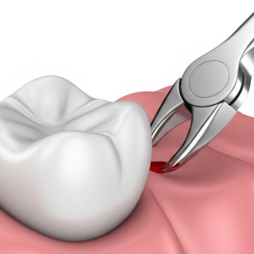Tooth Extraction: When Is It Necessary and What to Expect